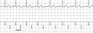 ICD-Detektionsalgorithmen 355 Abb. 9.16 Bipolares, rechtsventrikuläres Elektrogramm (V-EGM), obere Ableitung R-Wellen unter Sinusrhythmus, untere Ableitung ventrikuläre Signale bei Kammerflimmern.