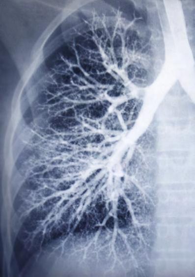 Leben & 35 COPD (chronisch-obstruktive Lungenerkrankung) Die vier Buchstaben setzen sich aus dem englischen Begriff wie folgt zusammen: Chronic Obstructive Pulmonary Disease.