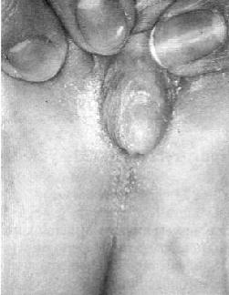 - Klinik - Genitalveränderungen bei Geburt (Mädchen) Prader 1-5 (Verkennung als Junge möglich) Inneres Genitale immer weiblich Virilisierung, Pseudopubertas präcox (bd.