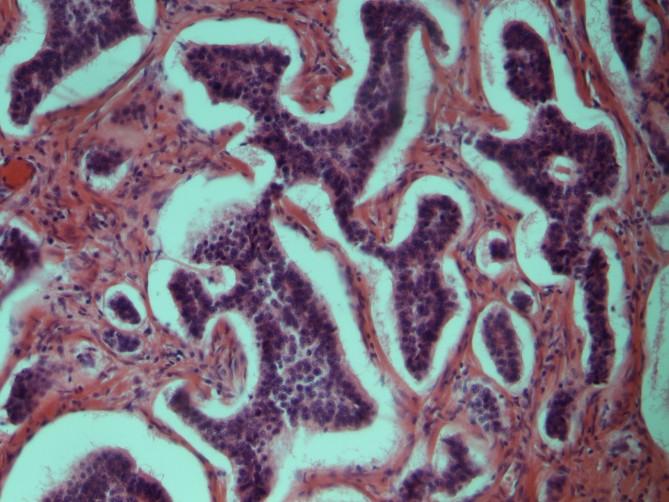 2.3 Morphologie GEP-NET präsentieren sich als feste (submuköse) Knoten. Auf dem Anschnitt sind sie typischerweise gelblich-grau (in Ileum oder Appendix) oder blass weiß (Klöppel 2003, Pinchot et al.