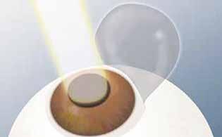IMAGEnet 6 Kompatibilität Postrefraktive IOL Bei Augen, die vorher eine refraktive Behandlung mit RK, PRK, Lasik, Lasek, LT oder PTK hatten, liegen die sphärischen