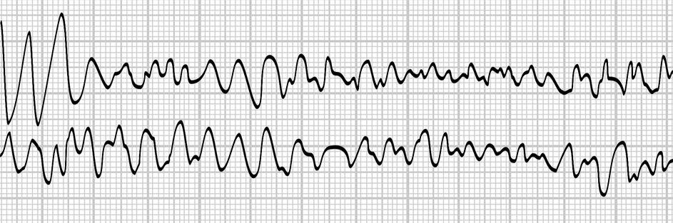 Kammerflimmern rasch, unkoordiniert, multifokale Reizbildung Komplexe Grundlinienschwankung Wellen wechelnder Amplitude keine QRS-Komplexe keine P-Wellen hämodynamisch = Herzstillstand
