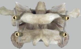 Abbildung 18: Verschraubung nach Harms, hier ohne Knochenspanimplantat, Ansicht von dorsal, aus Kandziora, 2010 [89].