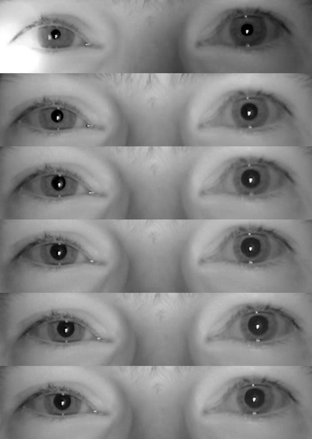 Abb. 2 9 Horner-Syndrom: Ausschnitte aus einem Infrarotvideo im Abstand von 3 s. Im obersten Bild sieht man noch den Lichtkegel, der vonderpupille wegbewegtwird.die normale linke Pupille hat im 3.