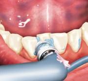 Hartnäckige bakterielle Beläge sind wie bei Erwachsenenzähnen die Hauptursache für Karies und Zahnfleischentzündungen.