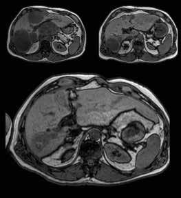 3 Neuroendokriner CUP links bei Erstdiagnose, rechts nach CTX mit Cisplatin + Etoposid und CT-gesteuerter Brachytherapie.