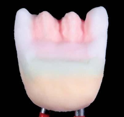 ternativ auf die approximalen Flanken aufgelegt, verstärkt diese Masse den Lichttransport im Interdentalbereich und zu den angrenzenden natürlichen Zähnen.