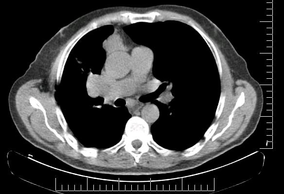 6. Diskussion 79 a) b) c) d) Abbildung 8: Falsch-positiver Lymphknotenbefund in der Nativ-CT, 70-jähriger Patient In der Nativ-CT (Bild a) fallen drei metastasenverdächtige Lymphknoten