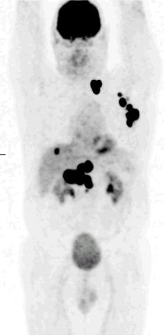 Schilddrüsenlappens lässt sich in der Nativ-CT (Bild a) nicht eindeutig abgrenzen.