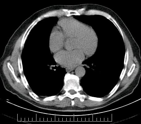 6. Diskussion 86 a) b) c) d) Abbildung 12: Falsch-negative Muskelmetastase in der CT, 70-jähriger Patient Nativ-CT (Bild a) und KM-CT (Bild b) ergeben zunächst keinen auffälligen Befund.