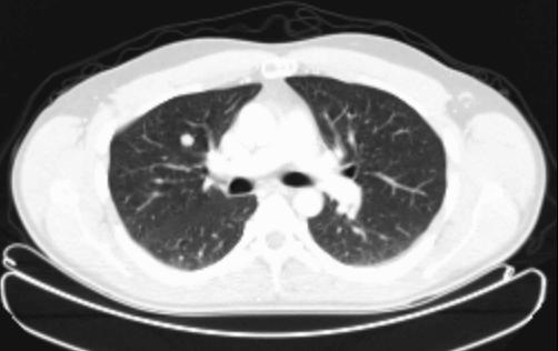 Lungenmetastase im rechten Oberlappen deutlich sichtbar.