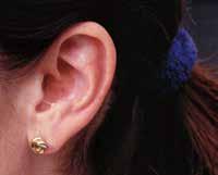 Tief-im-Gehörgang-getragenes-Hörgerät Das kleinste Modell der In-dem-Ohr-Geräte ist das Tief-im-Gehörganggetragene-Hörgerät (CIC).