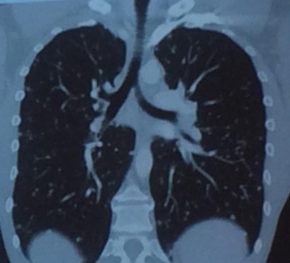 Differentialdiagnose der zufällige (random) Verteilung der Lungennoduli Entzündlich Tuberkulose Virus