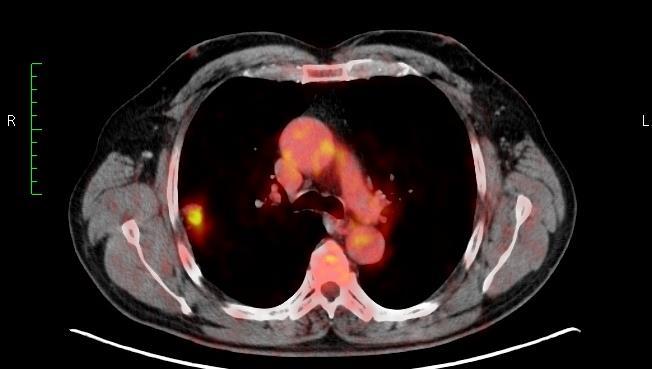 PET-CT und BAC Vall d Hebron Hospital,