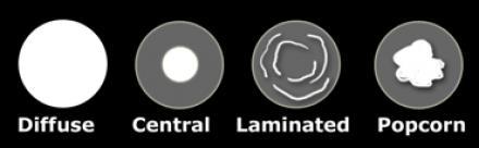 Die Morphologie der Lungenanomalien Annuläre (Ring-) Schatten (Läsion mit einer relativ scharfer Begrenzung und durchlässigem