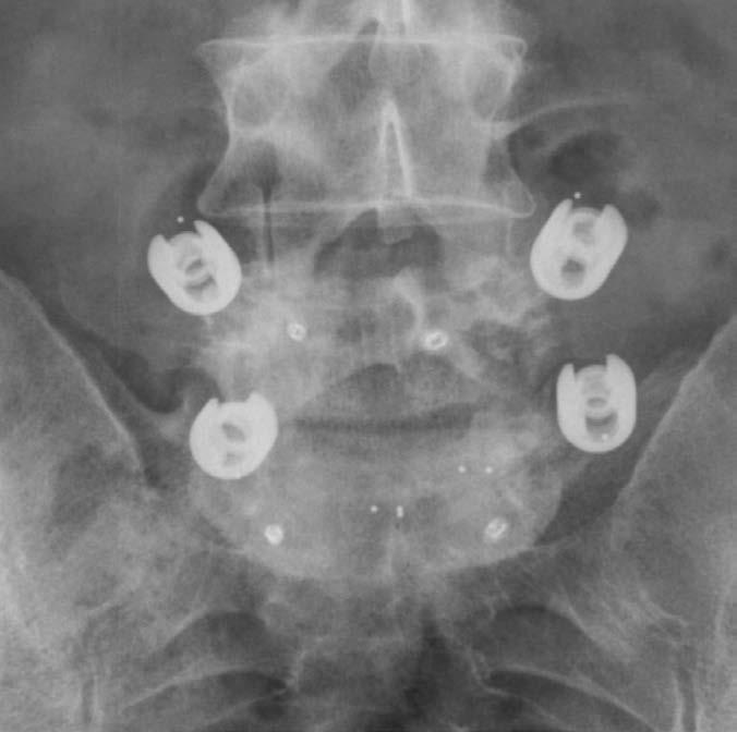 Intra-operatives Röntgen Intraoperative Röntgenbilder, L5/S1 versorgt mit