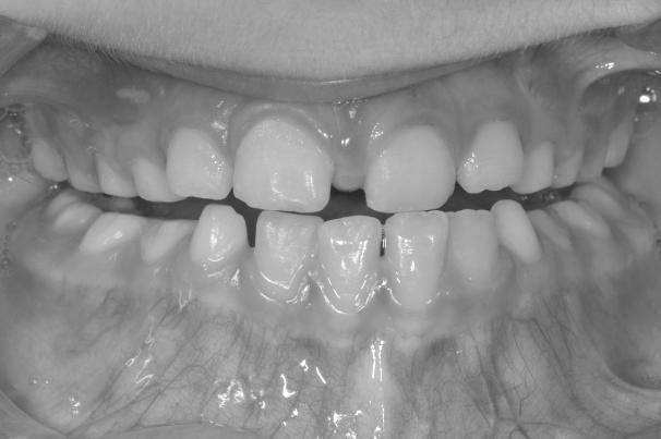 einzelner, mehrerer oder aller Frontzähne, bei dem es in der letzten Phase des Mundschlusses infolge dentaler Interferenzen zu einem Abgleiten des Unterkiefers nach anterior in die Kreuzbissstellung