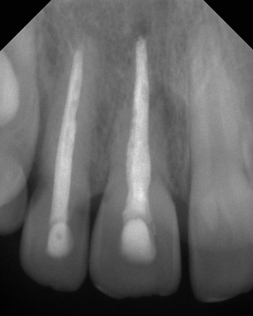 Intrusion des Zahns 12 sowie Schmelz-Dentin-Frakturen der Zähne 12, 11 und 21. Abb. 8: Zustand elf Wochen nach dem Trauma.