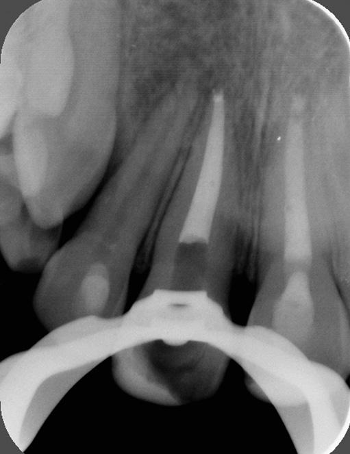 Eine Sensibilitätsprüfung der Zähne 12 und 21 lag nicht vor. Am nächsten Tag wurden zur Kontrolle ein Röntgenbild angefertigt (Abb. 9) und eine Sensibilitätsprüfung durchgeführt.