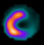 Herz-PET mit FDG (Fluordeoxyglukose) Hibernating myocardium : winterschlafendes Herzgewebe, dessen Durchblutung auch in Ruhe so stark herabgesetzt ist, dass es nicht mehr an der