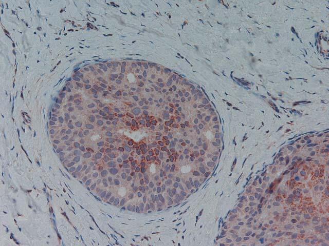Ergebnisse 35 Abbildung 13: Duktales Carcinoma in situ der Mamma (DCIS) mit p40-expression in den