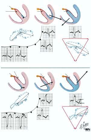 Schenkelblock und bradykarde rhythmusstörungen AV-Knoten QRS-Dauer über 0,12 s: breiteste QRS-Zacke in und linken Brustwandableitungen negativ, in rechten Brustwandableitungen positiv; P und PQ-Dauer