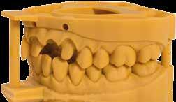 VarseoWax Surgical Guide Das Harz für den 3D-Druck von Bohrschablonen und Implantatprothetik-Einsetzhilfen VarseoWax Surgical Guide ist ein chemisch hochbeständiges Harz; die gedruckten Objekte