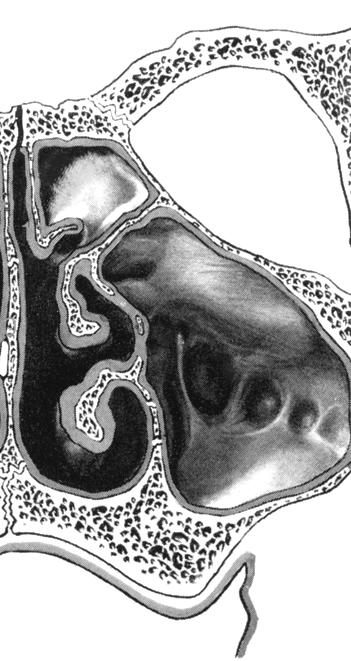 3 Die laterale Nasenwand Die Kieferhöhle (Sinus maxillaris, Antrum Highmori) als Bestandteil der Nasennebenhöhlen weist die Form einer vierseitigen Pyramide auf, deren Basis (mediale/nasale Wand) der