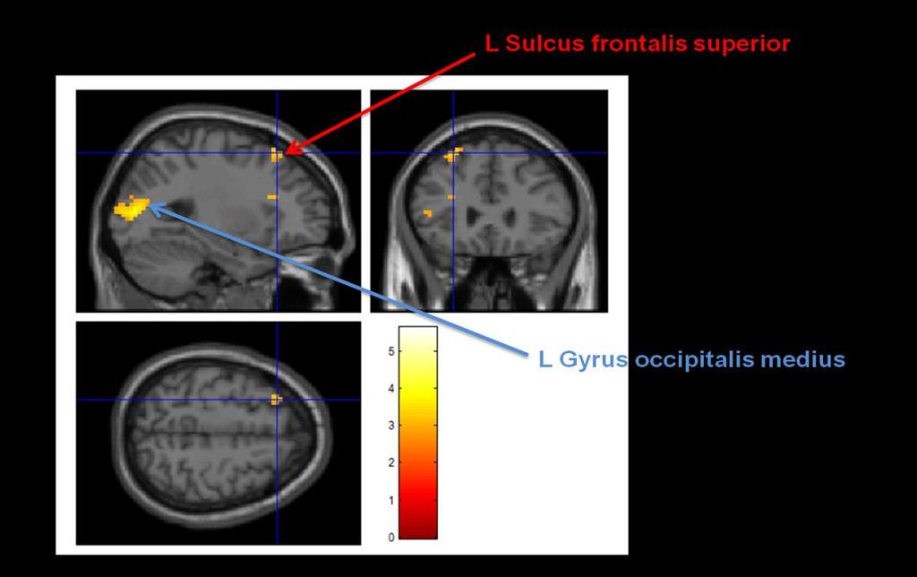 4 Diskussion dem Gyrus frontalis medius, dem tiefen frontooperkularem Kortex sowie dem Cerebellum, aktiv (Gruber and von Cramon 2001, 2003; Gruber 2001; Henseler et al. 2008).