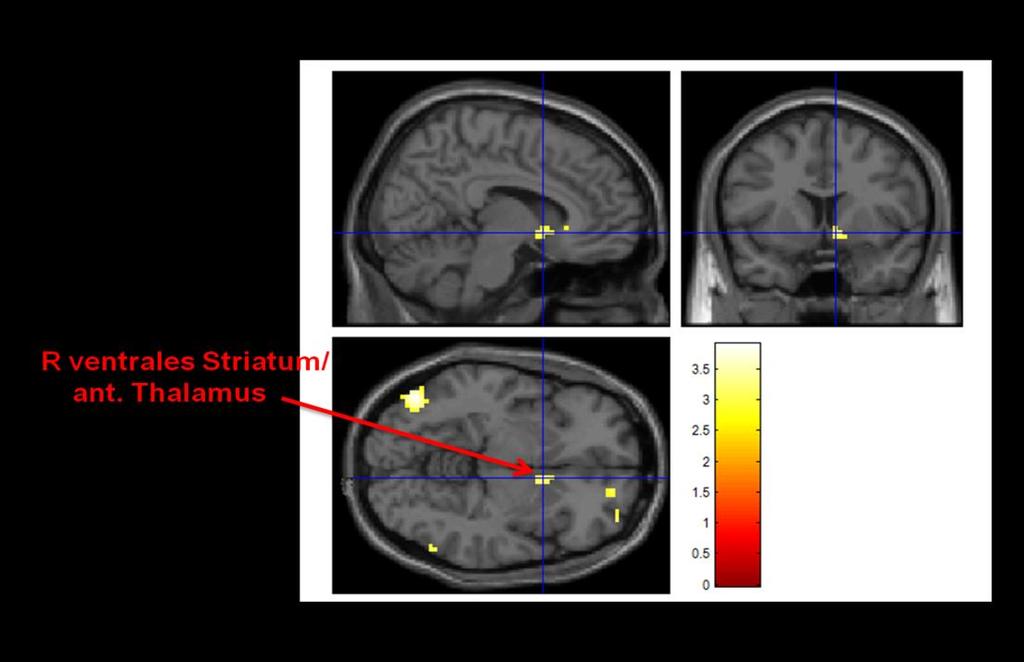 4 Diskussion Young et al. fand auch bei Schizophrenen eine verminderte Anzahl von Neuronen im anterioren und mediodorsalen Thalamus (Young et al. 2000). Auch MacDonald et al.
