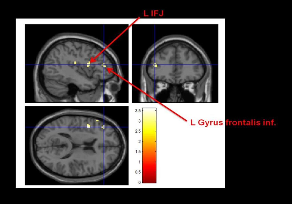 4 Diskussion Abb. 23: Die linke IFJ sowie der linke Gyrus frontalis inferior als potentielle Endpophänotypen während des kombinierten Oddball- und Inkongruenz-Paradigmas.