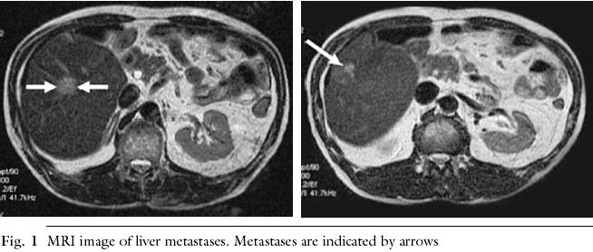 Lebermetastasen bei MRI