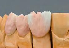 STANDARD-Schichtung am Beispiel einer Brücke wird das DENTINE in der kompletten Zahnform aufgebaut. Dadurch erhält man eine gute Orientierung hinsichtlich Größe, Form und Stellung der Zähne.