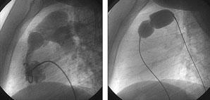 Abbildung 4: Angiografische Darstellung eines perimembranösen Ventrikelseptumdefekts unterhalb der Aortenklappe vor (links) und nach (rechts) Implantation eines asymmetrischen Amplatzer Membranous