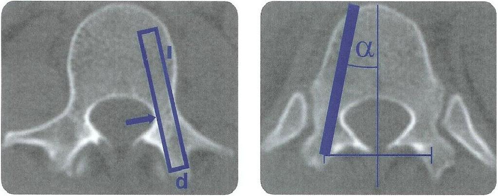 4.3 Operative Therapie - Dorsaler Zugangsweg Zu Beginn des Eingriffes steht die präoperative Planung anhand der angefertigten axialen Schnittbilder.