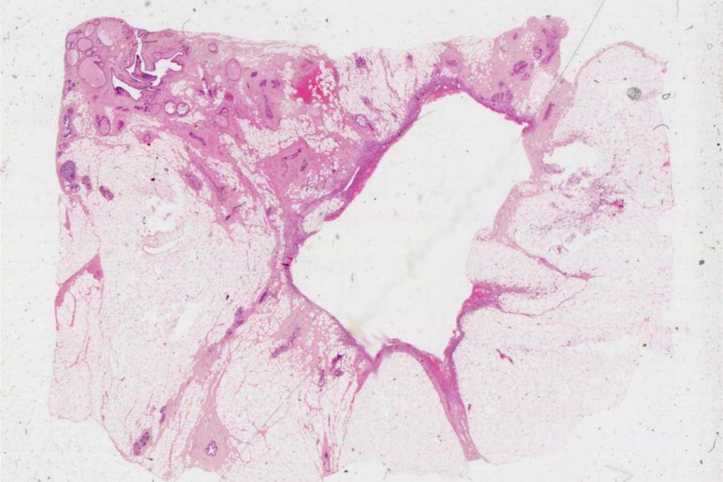Innerhalb des Herdes erkennt man den Gewebedefekt nach vorangegangener Core-Biopsie (Pfeil) b : HE- gefärbter Schnitt durch einen Gewebedefekt nach vorangegangener Mammotome Vakuumbiopsie (Pfeile)