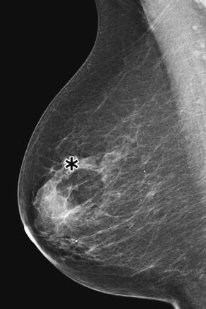 Abbildung 2: Invasiv lobuläres Karzinom einer 69-jährigen Patientin in der rechten Brust, visuell in der MLO ( Mediolateral-oblique )-Mammographieaufnahme (linkes Bild) erschwert abgrenzbar, vom CAD-