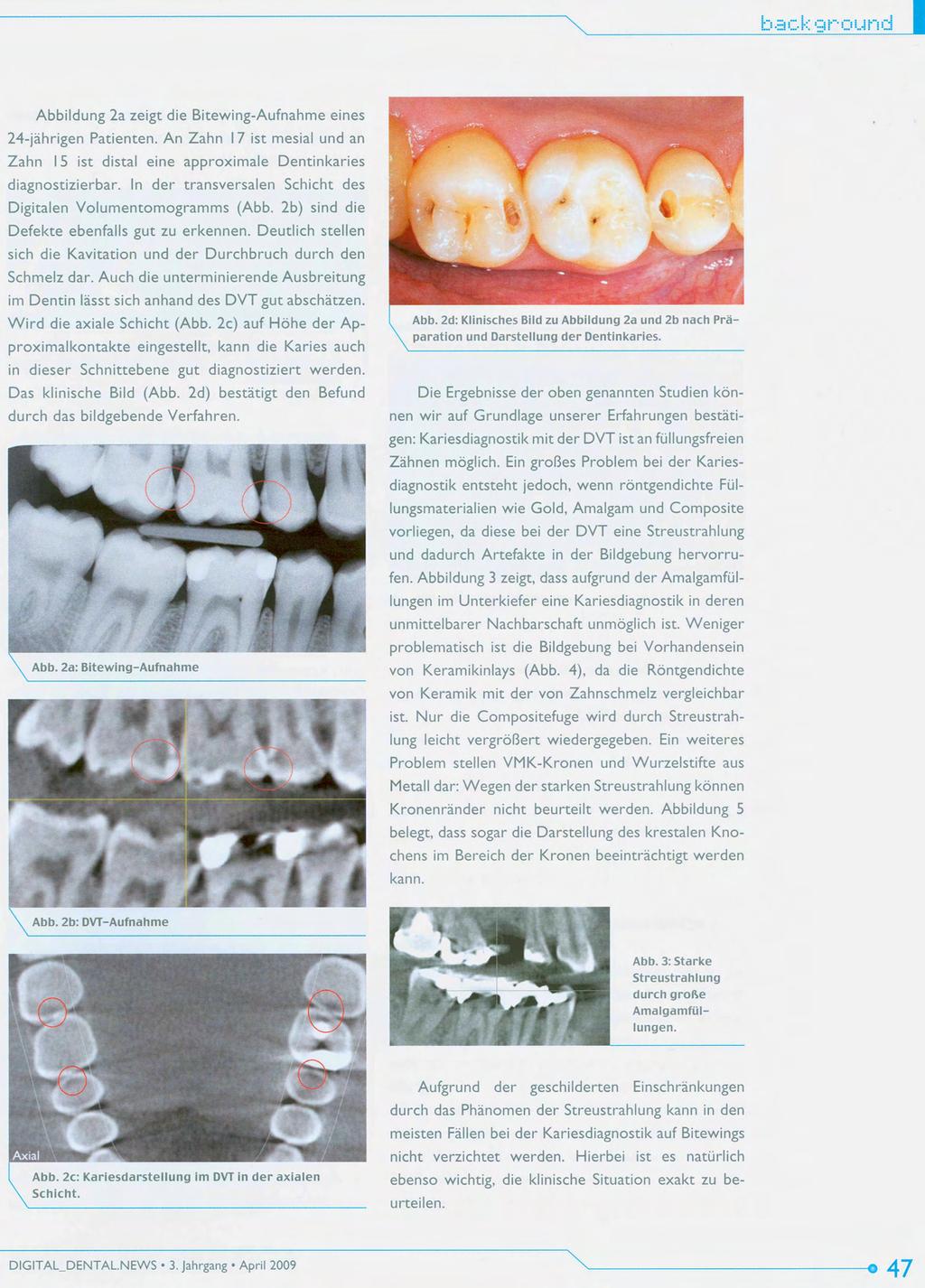 Abbildung 2a zeigt die Bitewing-Aufnahme eines 24-jahrigen Patienten. An Zahn 17 ist mesial und an Zahn 15 ist distal eine approximale Dentinkaries diagnostizierbar.