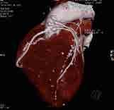 C FRAGESTELLUNGEN IN DEN FACHBEREICHEN PET/CT high definition Die hochauflösende PET erkennt und bewertet die Durchblutung, den Stoffwechsel und die Vitalität des Herzmuskels.