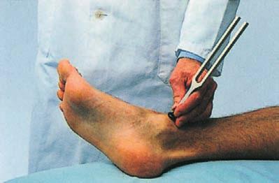 2 Klinischer Fall Reine Nervensache Mit der angeschlagenen Stimmgabel auf dem FußknoÈchel wird das Vibrationsempfinden gepruèft, das bei Polyneuro pathien typischerweise herabgesetzt ist