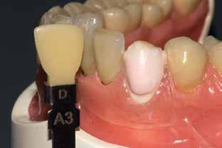 10 bis 12 Schließen des Inzisalbereichs mit einer Mischung aus Dentin und OE1 Verblendung