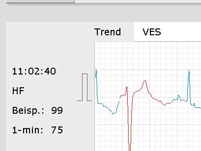 custo diagnostic gibt verschiedene Werte aus: Bildschirm Langzeit-EKG Übersicht Trend HF: Pro Minute werden die Herzaktionen gezählt und als Verlauf über die Zeit aufgetragen Zusammenfassung aus dem