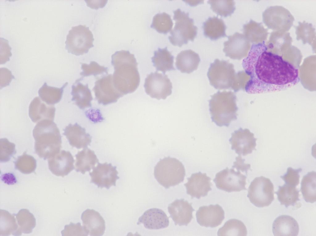 segmentkerniger Granulozyt Leukoerythroblastisches Blutbild bei KM-Karzinose