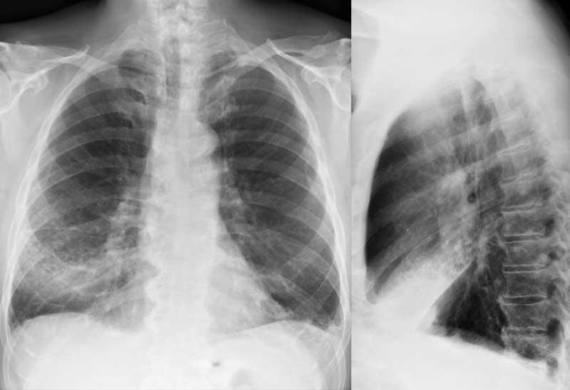 Späte Diagnose 63 jährige Patientin mit chronischem Mittellappen Infiltrat der Lunge Bronchoskopisch keine Stenose