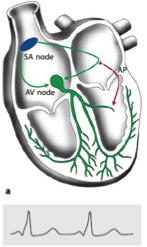 Schrittmacherzentrum etablieren. Wenn dieses unterhalb der His-Bündel-Aufzweigung (infrahisär) lokalisiert ist, zeigt sich das Bild eines ventrikulären Ersatzrhythmus mit breiten Komplexen.