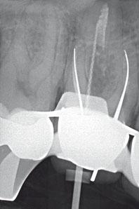 Brandt Endodontische Rehabilitation von drei benachbarten Zähnen 63 noch fehlenden 4. Wurzelkanal (mb2) aufzufinden und bis zur Konfluenz mit dem mb1 zu präparieren.