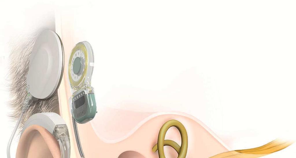 Die Operation Der interne Teil eines CI-Systems wird hinter dem Ohr unter die Haut implantiert. Der Chirurg führt den Elektrodenarray in die Cochlea ein.
