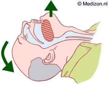 Gebrauch des Lifeline AED Überprüfung der Atmung 1. Atemwege frei machen -durch Anheben des Kinns, den Hals überstrecken 2. Max.
