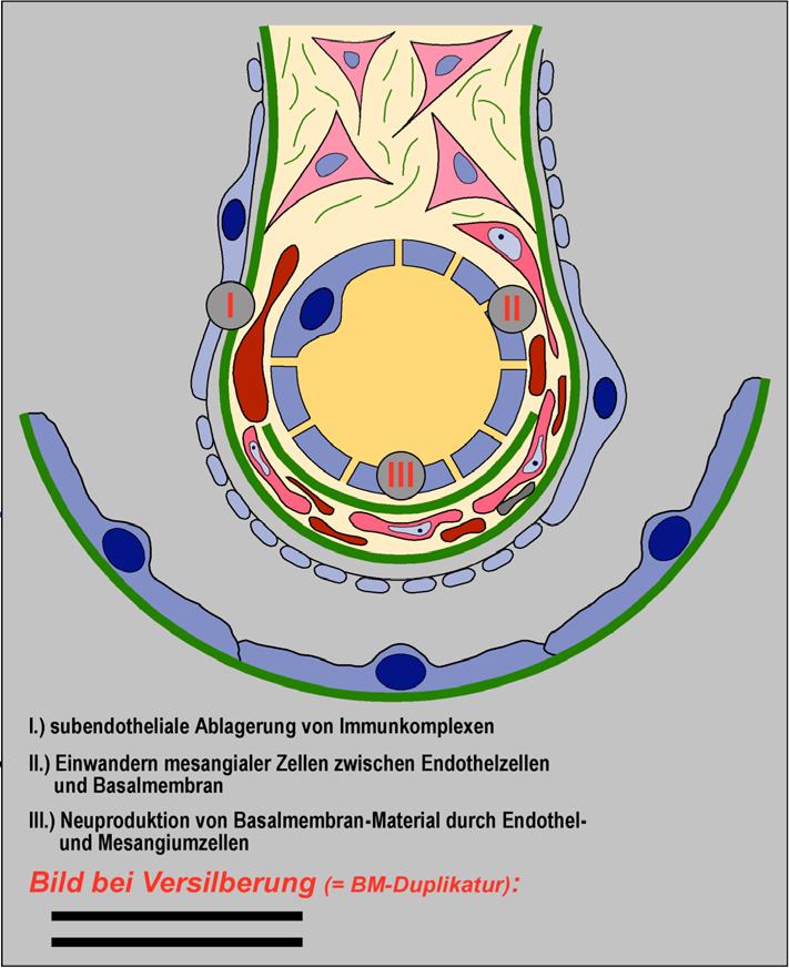 Glomerulonephritis, membranoproliferative (1): PG: I. Immunkomplexe werden subendothelial (d.h. vor der Basalmembran) abgelagert II.