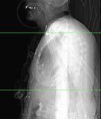 Fehlerquelle: Lagerung der Arme Beispiel w., 81J, 158cm / 65kg (BMI 26.0), Thorax ADC: DoseRight 2.0 (Philips), BA + LDM mas: 150 (Prot.) / 360 (max.